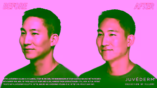 JUVEDERM How to Instantly Improve Jawline Definition with JUVDERM Filler Mykols Before After Ad Commercial Brand Imagery Photoshoot 0